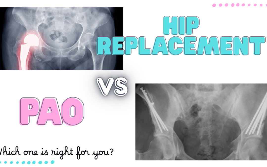 PAO vs Hip Replacement: Key Differences